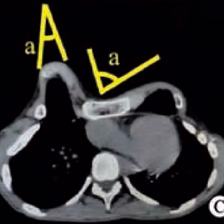 What is&nbsp;Acute Angle Deformity？