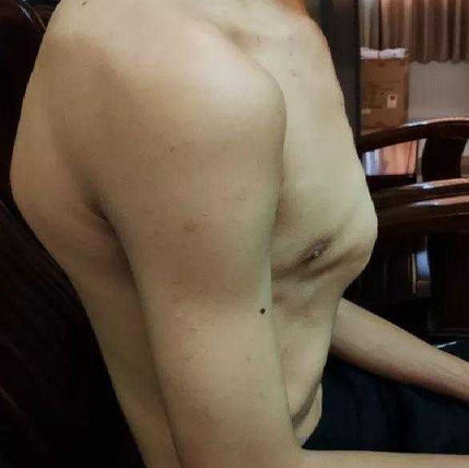 Chest wall appearance before surgery