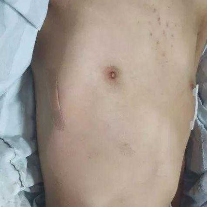 Chest wall appearance after surgery