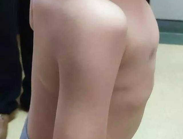 The World's First  Successful Chest Wall Reconstruction Surgery for A Patient with Flatback Sydrome