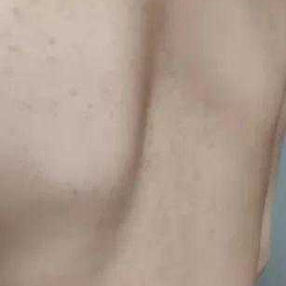 The patient&rsquo;s thoracic spine lacks its natural curvature