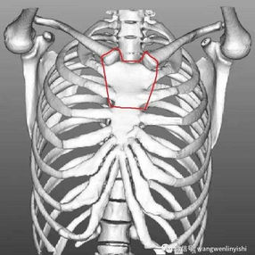 Designated area for excision on the anterior chest wall