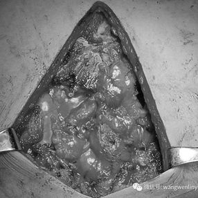 The significantly enlarged thymus, occupying extensive space in the anterior mediastinum, was completely excised in the surgery