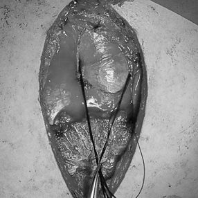 A sling was placed around the ascending aorta