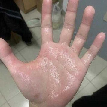 Minimally Invasive Surgery for A Patient with Hyperhidrosis for 10 Years