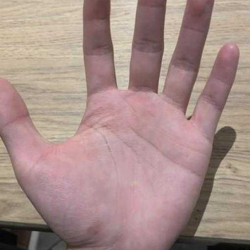 After surgery, the hand sweating has been completely resolved